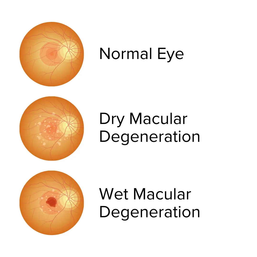 Macular Degeneration