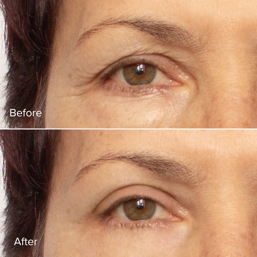 Cosmetic Eye Surgery Stuart Treasure Coast Florida