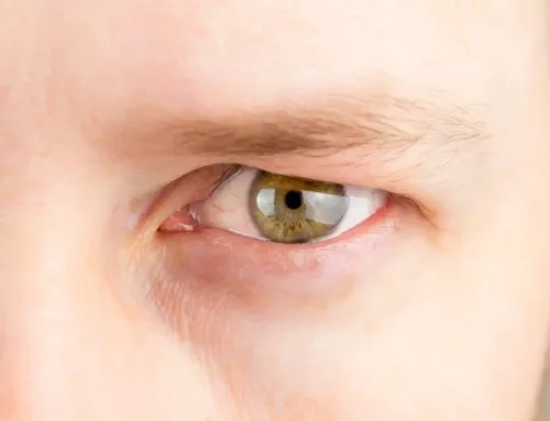 What are the Treatment Options for Droopy Eyelids?