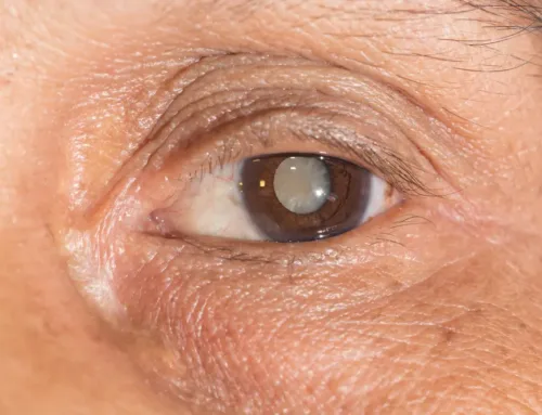 Recognizing Symptoms of Cataracts: Blurry Vision, Glare Sensitivity, and More